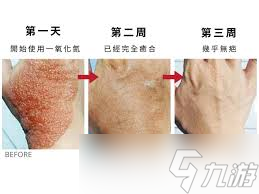 烫伤后皮肤发红没破皮没水疱哪种处理方法正确