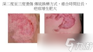 烫伤后皮肤发红没破皮没水疱哪种处理方法正确